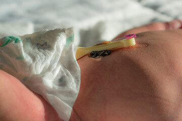 bebe recién nacido con pañal y pinza color amarillo que sujeta el cordón umbilical