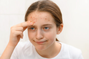 a disappointed teenage girl looks in the mirror at her face with pimples, touches her face, she is...