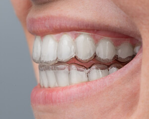 Fototapeta premium Close-up of a caucasian woman smiling with aligners on her teeth. Macro.