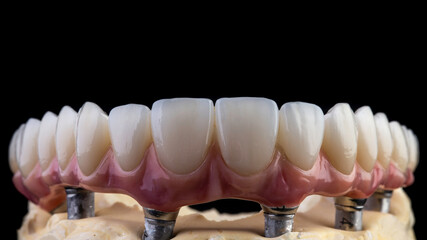Dental implants and dentures in close-up Siemke on a black background
