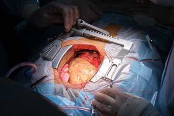 Closeup of professional doctor hands operating a patient during open heart surgery in surgical...