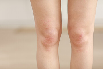 skin allergies, legs skin women. Closeup of red pustules on a knee, an allergic reaction caused by atopic dermatitis. Selected focus