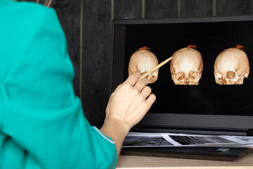 3d computed tomography of the brain with a fracture of the frontal part of the skull on laptop screens on the table on laptop screens