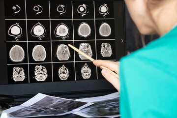 3d computed tomography of the brain with a fracture of the frontal part of the skull on laptop...