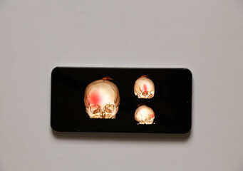 3D computed tomography of the brain with a fracture of the frontal part of the skull after injury...