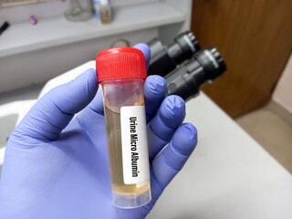 Urine Sample for Urine Microalbumin test with laboratory background. Closeup. Urinalysis. selective focus