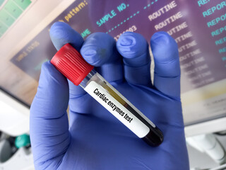 Scientist holding blood sample for cardiac enzymes test, myocardial infarction (MI), focus view