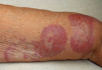 Granuloma annulare, a rare skin disease, on an arm of a  patient.