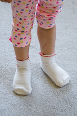 A girl's toes in socks with a scratch on her left leg.