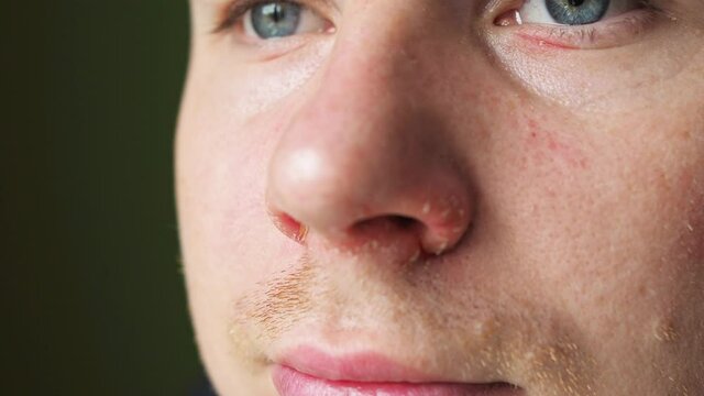 a sore nose after a runny nose close-up. cracked skin on the nose. sore skin on the face. male face close-up