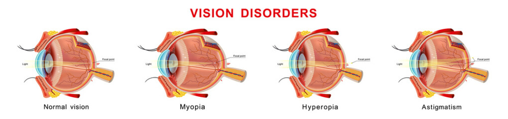 Eyesight disorders. Normal eye, myopia, hyperopia and astigmatism - obrazy, fototapety, plakaty
