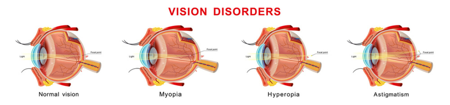 Eyesight disorders. Normal eye, myopia, hyperopia and astigmatism