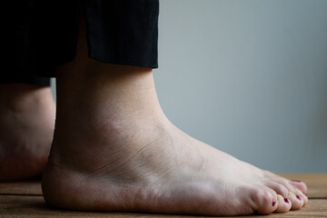 Close-up of person with a sprained ankle and a foot that is still a bit swollen and bruised after...