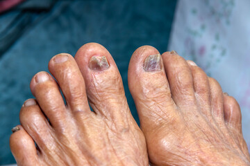 Fototapeta premium Leg of the elderly person to check for symptoms of illness,health care concept