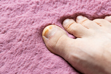 onychomycosis, the initial stage of ringworm. Big toe infected with fungal bacteria, Background...