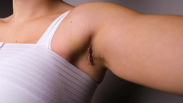 Close Up Of Females Armpit Scar Post Transaxillary Breast Augmentation .