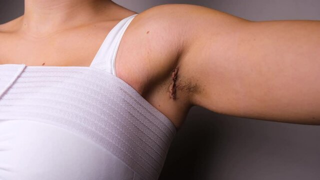 Woman Lifting Hand Slowly And Showing Armpit Scar Post Breast Augmentation. - Close Up