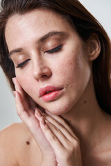 Brunette woman with pimples at her skin posing with closed eyes