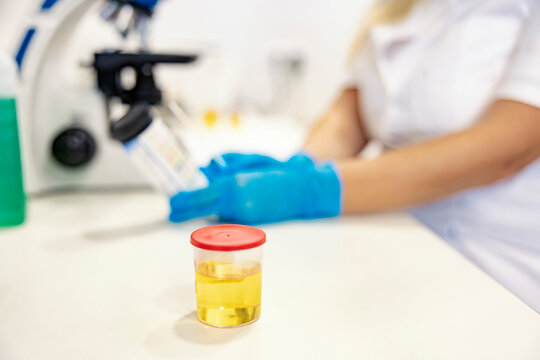 A bottle with a urine sample. Biochemistry. A bottle with a urine sample on a table in a lab. In a blurry background, a nurse analyzes samples with a microscope.