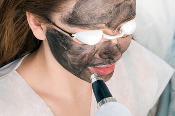 Carbon peeling of the face of a young beautiful woman. Peeling skin renewal.