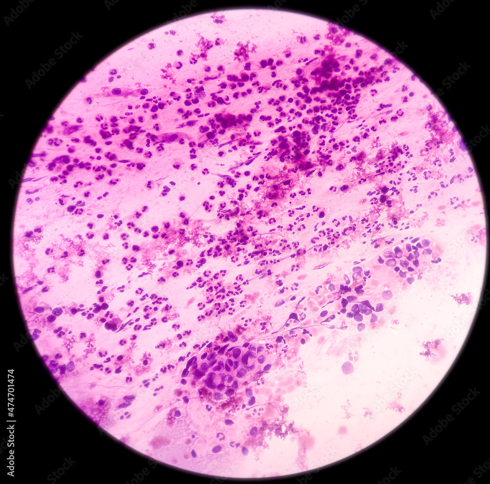 Poster High grade squamous intraepithelial lesion(HSIL). Photomicrograph of conventional pap smear. Reactive cellular changes associated with severe inflammation. Focus view.