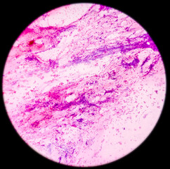 High grade squamous intraepithelial lesion(HSIL). Photomicrograph of conventional pap smear. Reactive cellular changes associated with severe inflammation. Focus view.