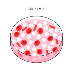 Leukemia cancer disease