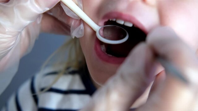 dentist, doctor examines oral cavity of small patient, uses mouth mirror, closeup baby teeth child, concept pediatric dentistry, dental treatment, correction of occlusion, oral care, caries prevention