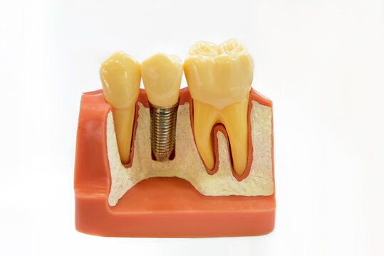 Zahnersatz, Zahnimplantat