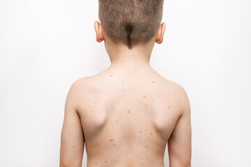 A cropped shot of a child standing with his back with a red rash on his body isolated on a white...