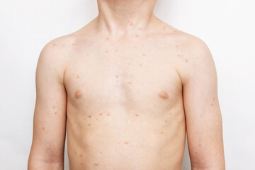 A cropped shot of a child with a red rash on his body isolated on a white background. Chickenpox,...