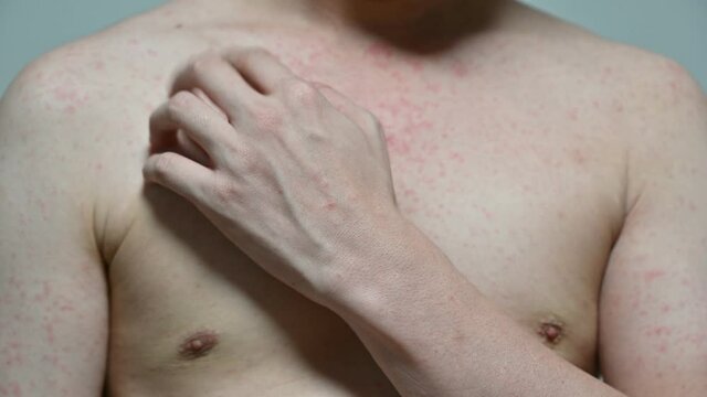 Dermatitis viral disease of young adult asian body standing scratching with itching, Red Rash, Measles Virus, Viral Exanthem