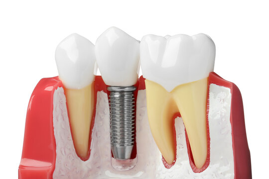 Educational model of gum with dental implant between teeth on white background