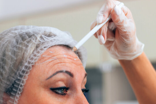 Marking by a master beautician of the forehead and between the eyebrows for botox injections. Patient in medical disposable cap before the procedure