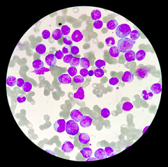 Photomicrograph of Acute Myeloblastic Leukemia (AML), a cancer of white blood cell. Microscopic...