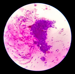 Pap's smear pap stain Microscopic 100x Zoom show High-grade squamous intraepithelial lesion (HSIL)...