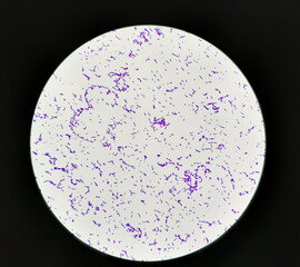 Streptococcus pyogenes infected in aged patient, showing of gram's stain from positive hemoculture.