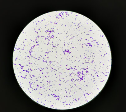 Streptococcus pyogenes infected in aged patient, showing of gram's stain from positive hemoculture.
