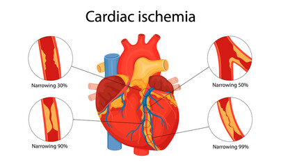 cardiac ischemia. anatomical illustration drawn in cartoon style - obrazy, fototapety, plakaty