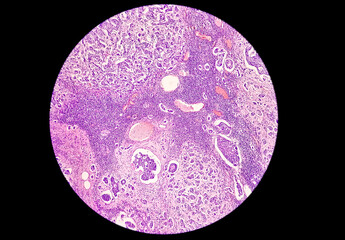 Low power photomicrograph of a breast core biopsy showing an invasive ductal carcinoma grade-II,  most common form of breast cancer. Lymphovascular invasion: Present
