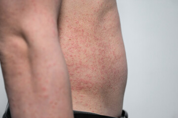 Dermatitis rash viral disease with immunodeficiency on body of young adult asian, scratch with itch