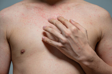 Dermatitis rash viral disease with immunodeficiency on body of young adult asian, scratching with itching