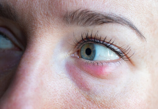 Stye on the women eye, inflammation century , infection