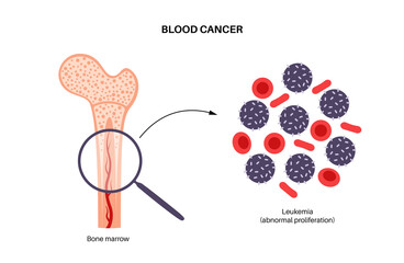 Leukemia cancer disease - obrazy, fototapety, plakaty