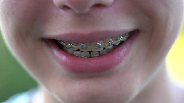 Close-up view 4k video of smiling mouth of young white kid with overbite teeth and metal modern braces construction on them