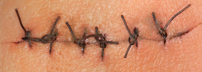 stitched scar on the skin