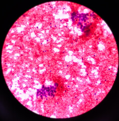 Parotid swelling, malignant cell consistent with mucoepidermoid carcinoma, squamous cells, chronic inflammatory cells and hemorrhage background, FNAC