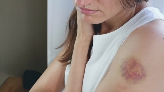 A woman in a white T-shirt by the window touches a large bruise on her arm with her hand. Domestic violence concept