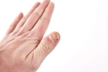 Nail fungus on hands disease. Fungal infection on nails hands, finger with onychomycosis, damage on...