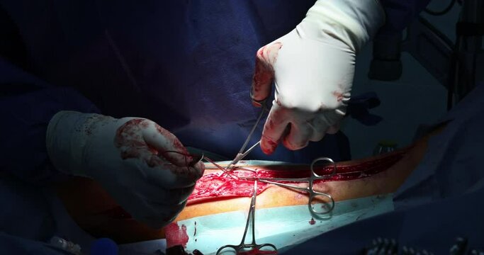 Operating room cutting legs for internal intervention during surgery
